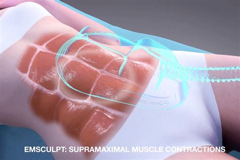 emsculpt pechange california|Emsculpt – Build Muscle .